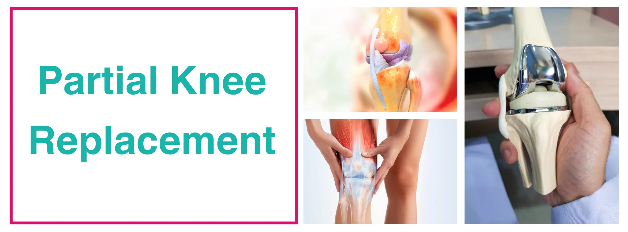 Partial Knee Replacement Surgery In Delhi | Dr. Rajesh Malhotra