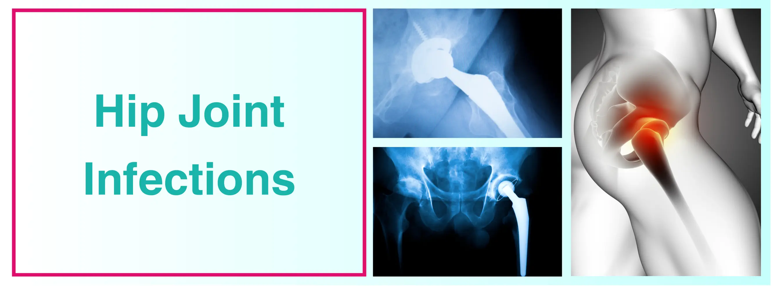 Addressing Hip Joint Disorders: Insights Into Infections And Treatment